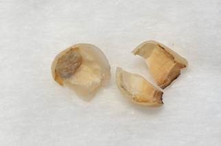 CAD/CAM冠が外れた方の例