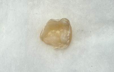 セラミックが脱離した方の例